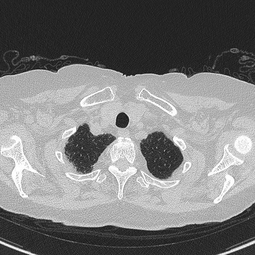 Amiodarone-induced pulmonary fibrosis (Radiopaedia 82355-96460 Axial lung window 7).jpg