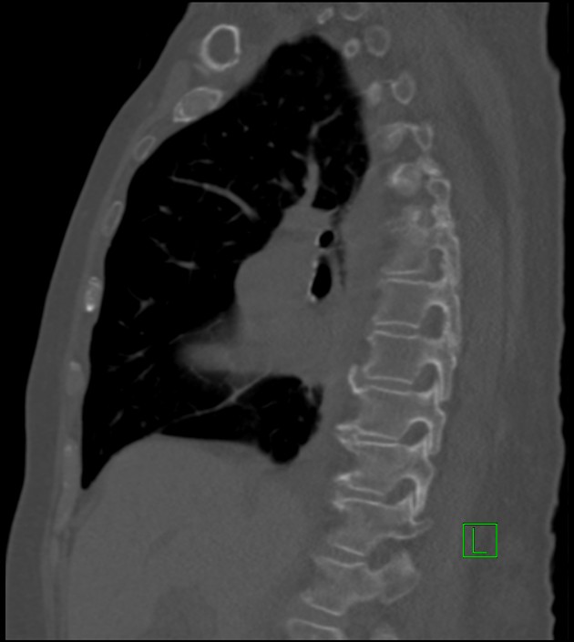 Amiodarone deposition in the liver (Radiopaedia 77587-89780 Sagittal bone window 59).jpg