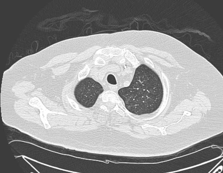 Amiodarone lung (Radiopaedia 62514-70769 Axial lung window 13).jpg