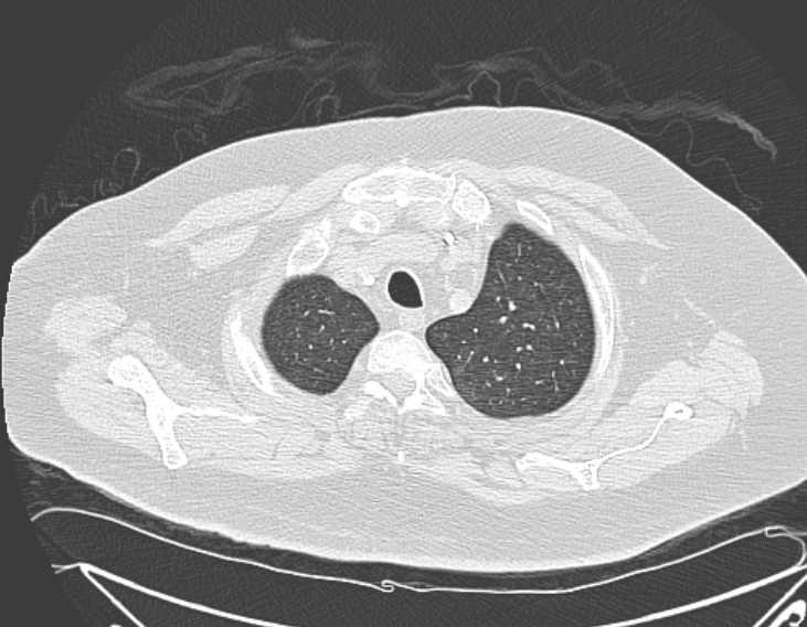 Amiodarone lung (Radiopaedia 62514-70769 Axial lung window 14).jpg