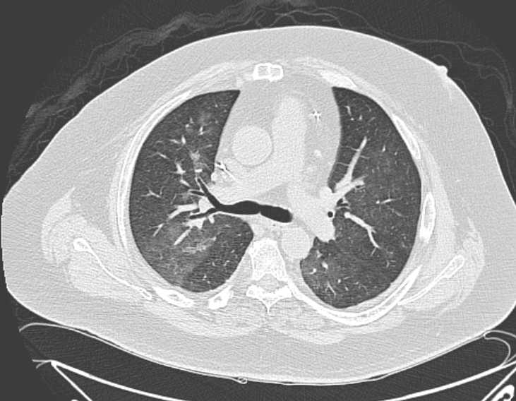 Amiodarone lung (Radiopaedia 62514-70769 Axial lung window 37).jpg