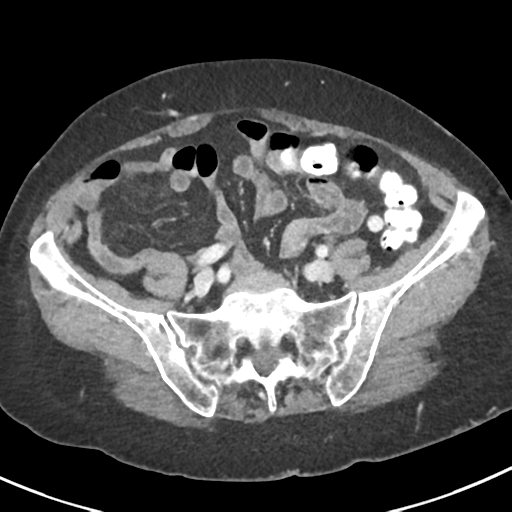 Ampullary adenocarcinoma (Radiopaedia 34013-35237 C 39).png