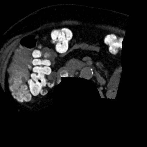 Ampullary adenocarcinoma (Radiopaedia 34013-35241 AXIAL MIPS 3-1.5 92).png