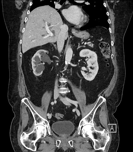 Ampullary adenocarcinoma (Radiopaedia 59373-66734 D 60).jpg