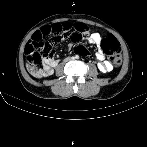 Ampullary adenocarcinoma (Radiopaedia 86093-102032 A 35).jpg