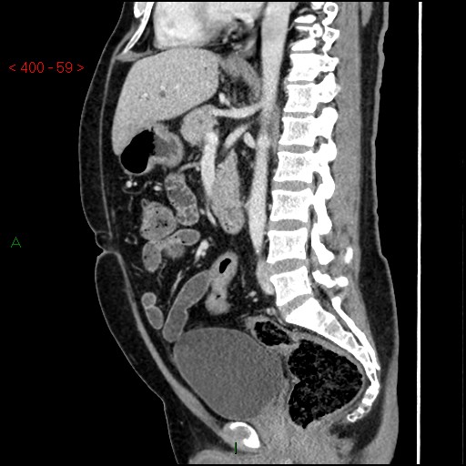 Ampullary carcinoma (Radiopaedia 56396-63056 D 58).jpg