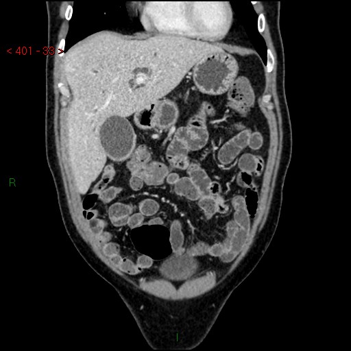 Ampullary carcinoma (Radiopaedia 56396-63056 E 32).jpg