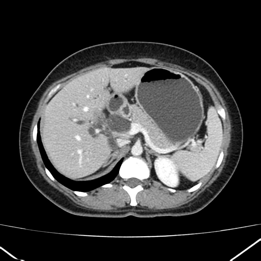 Ampullary tumor (Radiopaedia 22787-22816 C 19).jpg