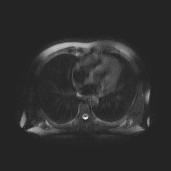 File:Ampullary tumor (Radiopaedia 27294-27479 T2 SPAIR 22).jpg