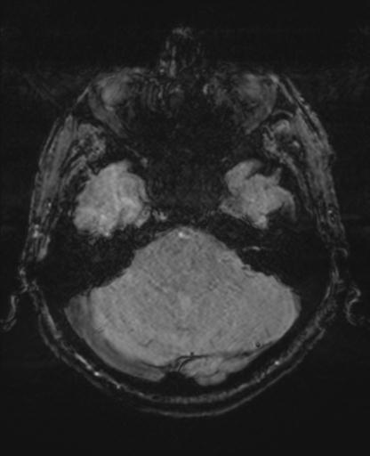 Amyloid angiopathy with inflammation (Radiopaedia 30360-31002 Axial SWI MAG 8).jpg