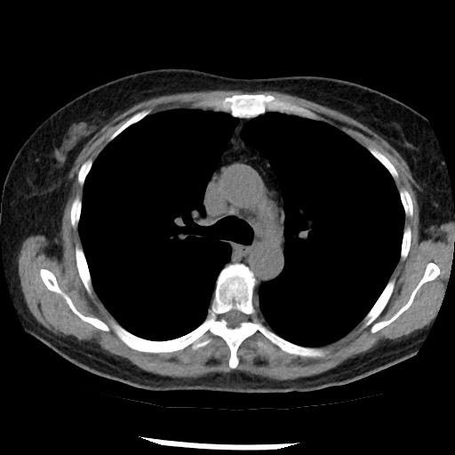 Amyloidosis - bronchial and diffuse nodular pulmonary involvement (Radiopaedia 60156-67744 Axial non-contrast 22).jpg