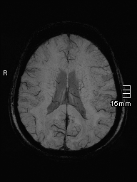 File:Amyotrophic lateral sclerosis (Radiopaedia 70821-81017 Axial SWI minIP 30).jpg