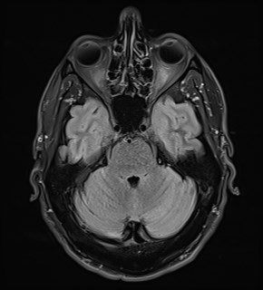 File:Amyotrophic lateral sclerosis (Radiopaedia 87352-103658 Axial FLAIR 8).jpg