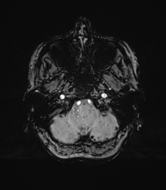 Anaplastic astrocytoma (Radiopaedia 86943-103160 Axial SWI 16).png