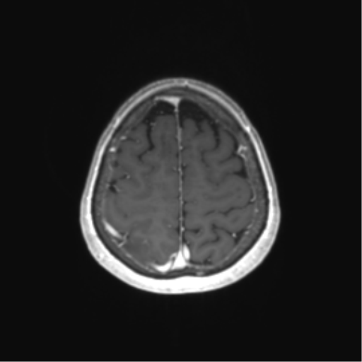 File:Anaplastic astrocytoma (Radiopaedia 86943-103160 Axial T1 C+ 73).png
