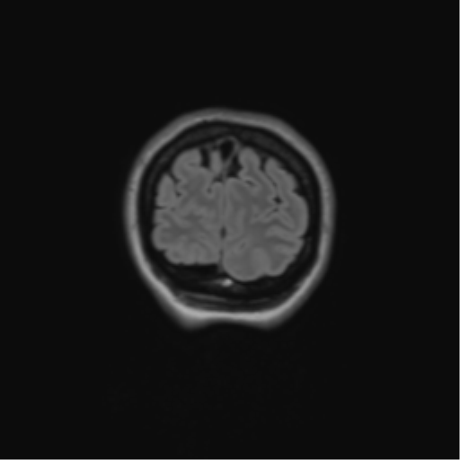 Anaplastic astrocytoma IDH mutant (Radiopaedia 50046-55341 Coronal FLAIR 8).png