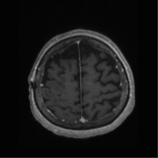 File:Anaplastic astrocytoma IDH wild-type (pseudoprogression) (Radiopaedia 42209-45277 Axial T1 C+ 104).png