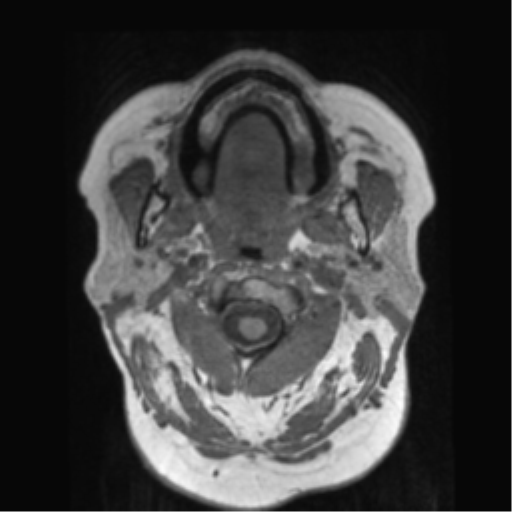 File:Anaplastic astrocytoma IDH wild-type (pseudoprogression) (Radiopaedia 42209-45278 Axial T1 6).png
