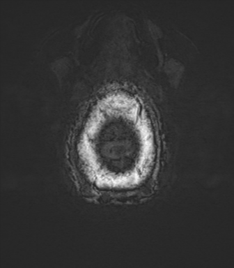 Anaplastic oligodendroglioma (Radiopaedia 83500-98599 Axial SWI 88).png