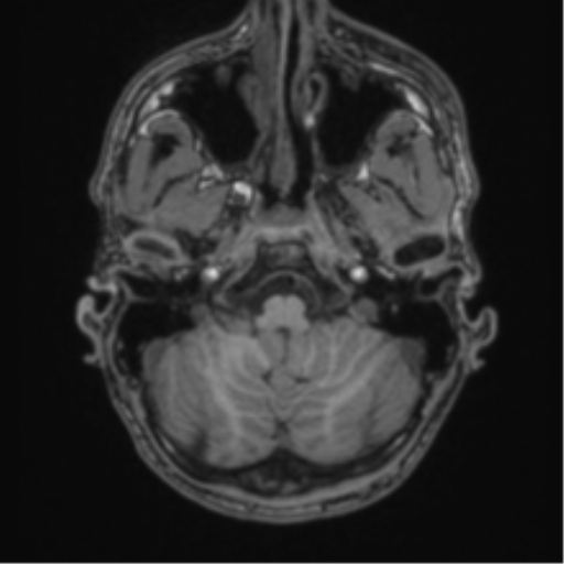Anaplastic oligodendroglioma with skull fracture (Radiopaedia 74831-85845 Axial T1 7).png