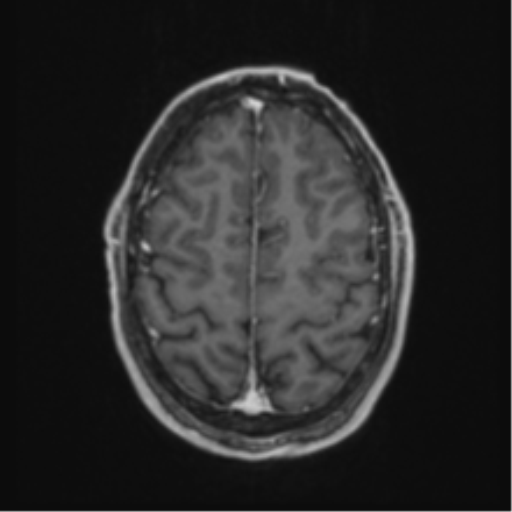Anaplastic oligodendroglioma with skull fracture (Radiopaedia 74831-85845 Axial T1 C+ fat sat 53).png