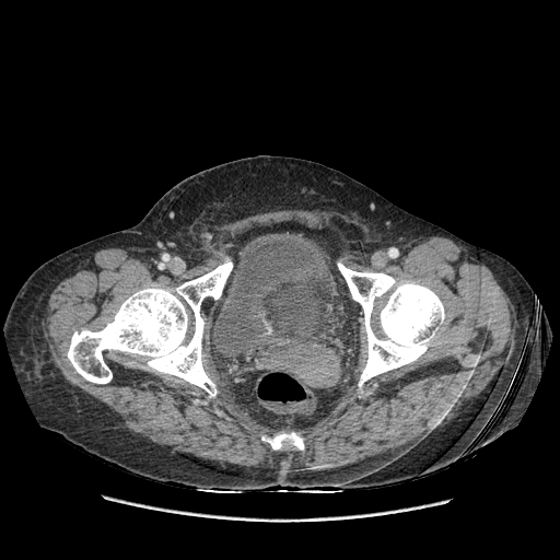 Anastomosis leak at ileostomy closure site (Radiopaedia 82138-96184 B 239).jpg