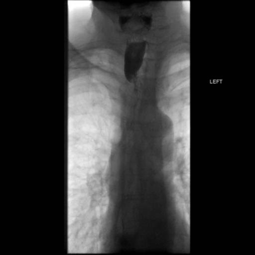 File:Anastomotic stricture post Ivor Lewis esophagectomy (Radiopaedia 47937-52715 B 8).png