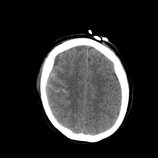 File:Aneursym related subarachnoid hemorrhage with hydrocephalus (Radiopaedia 45105-49085 Axial non-contrast 38).jpg