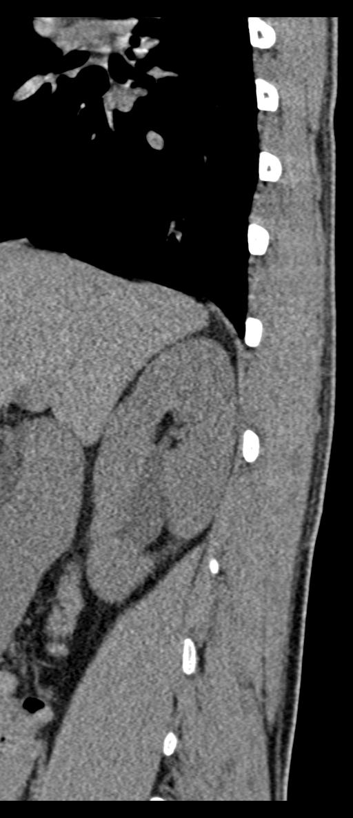 Aneurysmal bone cyst T11 (Radiopaedia 29294-29721 E 72).jpg