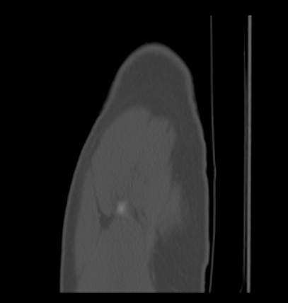 File:Aneurysmal bone cyst of ischium (Radiopaedia 25957-26094 Sagittal bone window 2).png