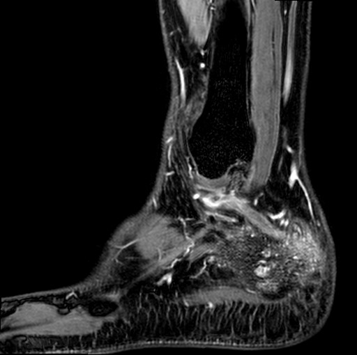 File:Aneurysmal bone cyst of the calcaneus (Radiopaedia 60669-68420 F 2).jpg