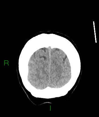 Aneurysmal subarachnoid hemorrhage with intra-axial extension (Radiopaedia 84371-99699 Coronal non-contrast 11).jpg