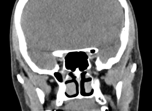 Angular dermoid cyst (Radiopaedia 88967-105790 Coronal non-contrast 45).jpg