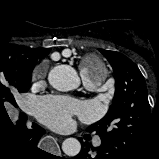 File:Anomalous left coronary artery from the pulmonary artery (ALCAPA) (Radiopaedia 40884-43586 A 15).jpg