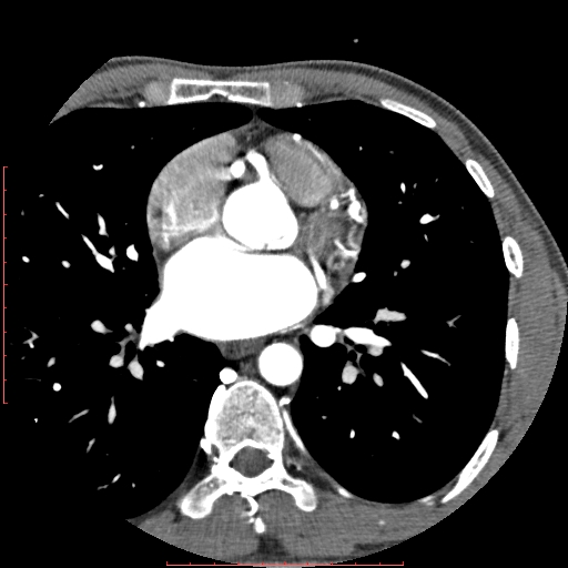 File:Anomalous left coronary artery from the pulmonary artery (ALCAPA) (Radiopaedia 70148-80181 A 131).jpg