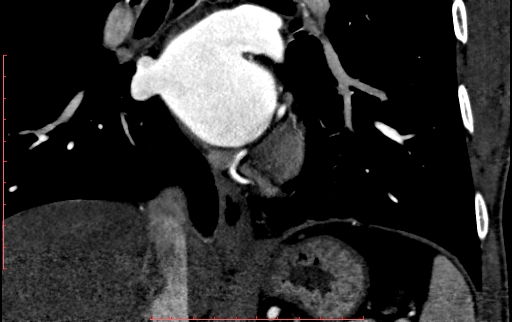 Anomalous left coronary artery from the pulmonary artery (ALCAPA) (Radiopaedia 70148-80181 B 217).jpg