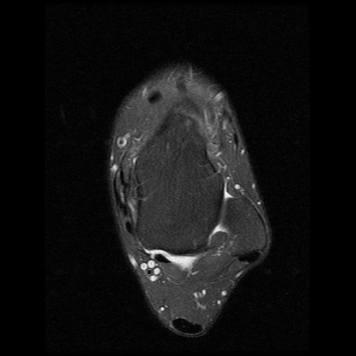 File:Anterior calcaneal process fracture (Radiopaedia 74654-85611 Axial PD fat sat 9).jpg