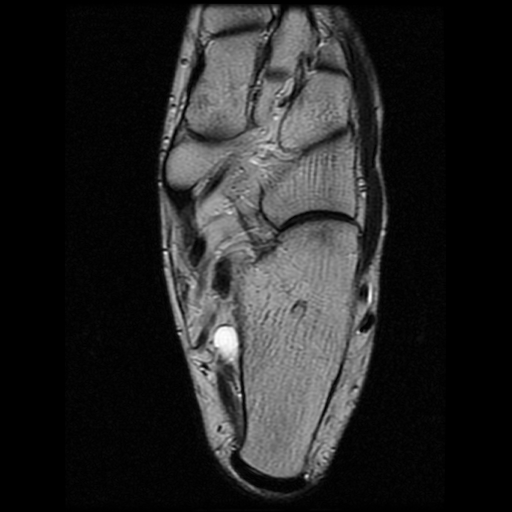 File:Anterior calcaneal process fracture (Radiopaedia 74654-85611 Axial T2 19).jpg