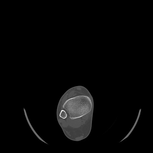 Anterior calcaneal process fracture (Radiopaedia 82590-96762 Axial bone window 7).jpg