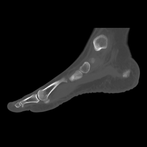 File:Anterior calcaneal process fracture (Radiopaedia 82590-96762 Sagittal bone window 7).jpg