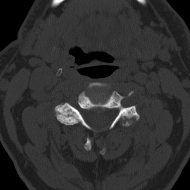 Anterior cervical postdiscectomy arthrodesis (Radiopaedia 32678-33646 Axial bone window 32).jpg