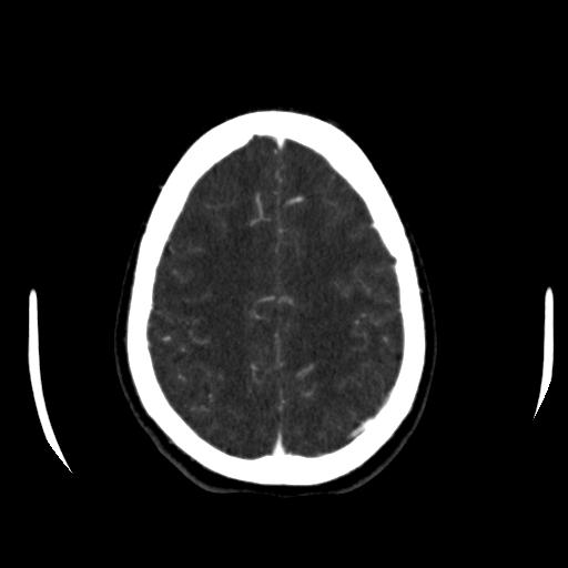 File:Anterior communicating artery aneurysm (Radiopaedia 16633-16335 A 35).jpg
