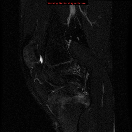 File:Anterior cruciate ligament injury - partial thickness tear (Radiopaedia 12176-12515 Sagittal T2 fat sat 8).jpg