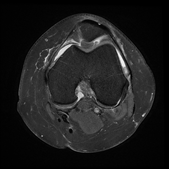 File:Anterior cruciate ligament tear, Wrisberg rip and bucket-handle tear of medial meniscus (Radiopaedia 75872-87266 Axial PD fat sat 16).jpg