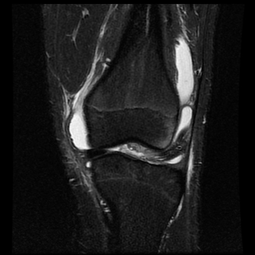 File:Anterior cruciate ligament tear (Radiopaedia 61500-69462 Coronal STIR 8).jpg