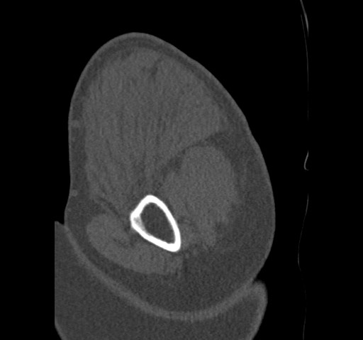 Anterior glenohumeral dislocation with Hill-Sachs lesion (Radiopaedia 62877-71249 Sagittal bone window 13).jpg