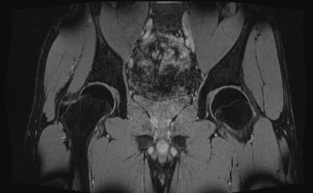 Anterior inferior iliac spine avulsion fracture (Radiopaedia 81312-95000 G 42).jpg