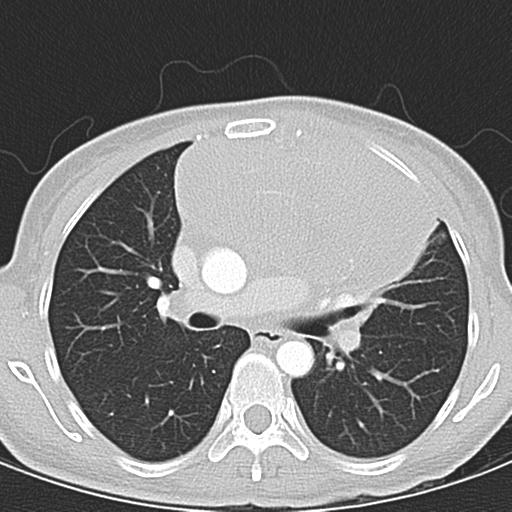 Anterior mediastinal lymphoma (Radiopaedia 29556-30061 Axial lung window 24).jpg