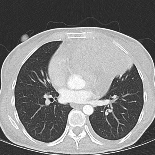 Anterior mediastinal lymphoma (Radiopaedia 29556-30061 Axial lung window 32).jpg