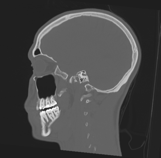 File:Anterior nasal spine fracture (Radiopaedia 46138-50494 Sagittal bone window 20).png